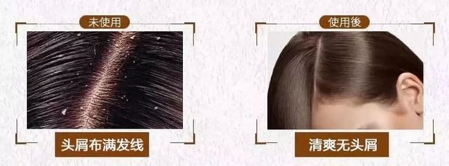 告別脫發、頭皮屑與頭發稀少的煩惱，重塑烏黑濃密的秀發