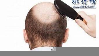 2024年脫發(fā)產(chǎn)品排行榜前十名 科學(xué)評測與選購指南